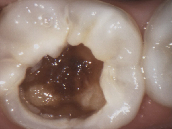 CHILD AGED 10 TREATMENT OF LOWER FIRST MOLAR ROOT CANALS AND E.MAX CERAMIC CROWN